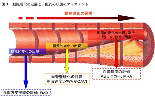 動脈硬化の進展と血管の状態変化を示した模式図。機能的変化から器質的変化、プラーク形成・狭窄へ進行し、それぞれに内皮機能検査や脈波伝播速度、ABIなどの評価法が用いられることを示している。